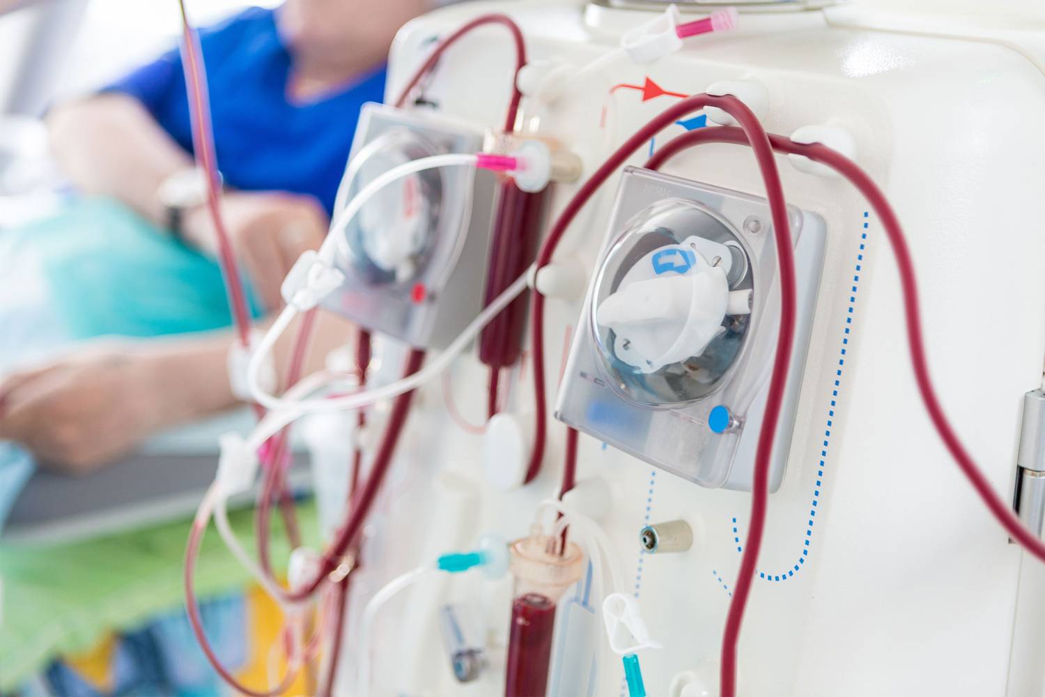 Benefits of Dialysis